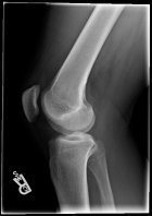 zdjęcie rentgenowskie kolana